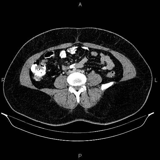 Bilateral ovarian dermoid cysts (Radiopaedia 85785-101603 A 67).jpg