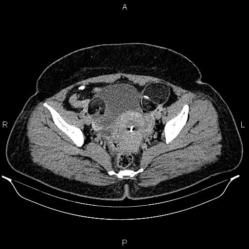 File:Bilateral ovarian dermoid cysts (Radiopaedia 85785-101603 A 92).jpg