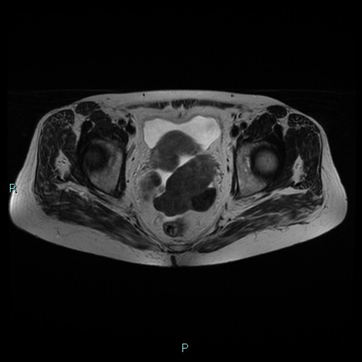File:Bilateral ovarian fibroma (Radiopaedia 44568-48293 Axial T2 18).jpg