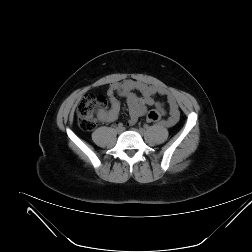 File:Bilateral ovarian mature cystic teratomas (Radiopaedia 79373-92457 Axial non-contrast 36).jpg