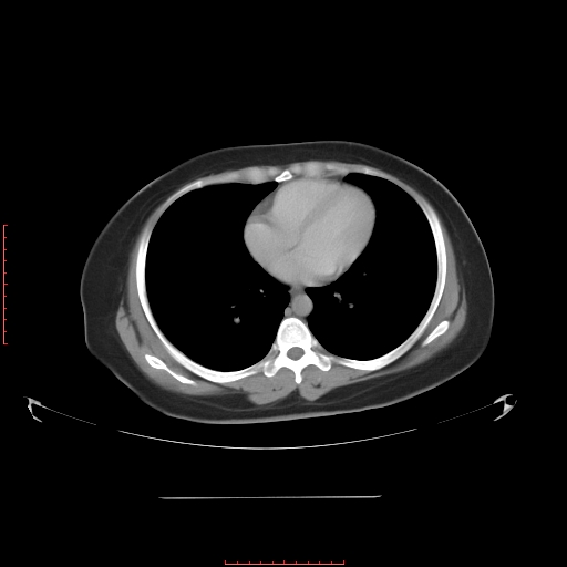 File:Bilateral ovarian serous cystadenocarcinoma with right ovarian torsion (Radiopaedia 32640-33611 A 1).jpg
