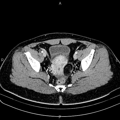 Bilateral ovarian teratoma (Radiopaedia 83131-97503 Axial With contrast 49).jpg