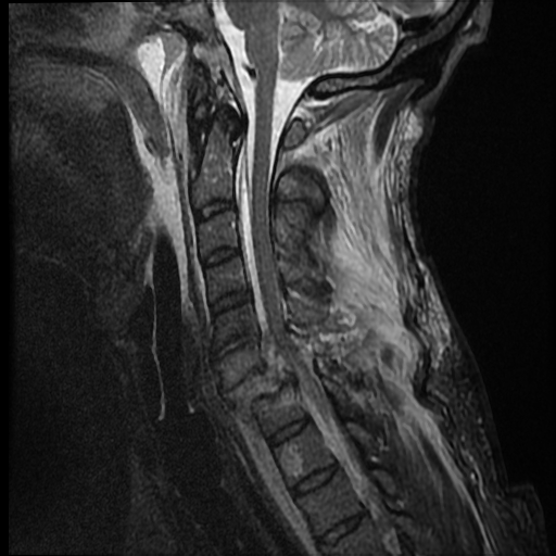 File:Bilateral perched facets with cord injury (Radiopaedia 45587-49714 Sagittal STIR 9).jpg