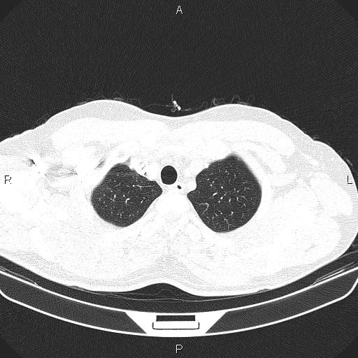 File:Bilateral pulmonary AVM (Radiopaedia 83134-97505 Axial lung window 11).jpg