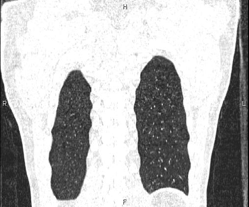 Bilateral pulmonary AVM (Radiopaedia 83134-97505 Coronal lung window 71).jpg