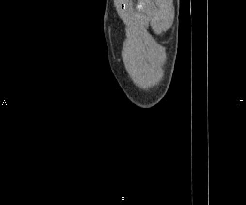 Bilateral pulmonary AVM (Radiopaedia 83134-97505 D 118).jpg