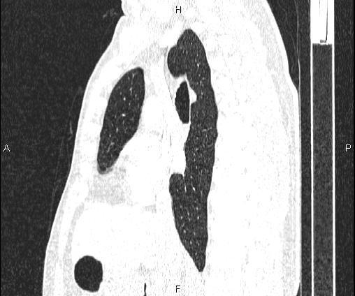 Bilateral pulmonary AVM (Radiopaedia 83134-97505 Sagittal lung window 55).jpg