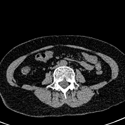 Bilateral staghorn calculi (Radiopaedia 59475-66842 Axial non-contrast 42).jpg