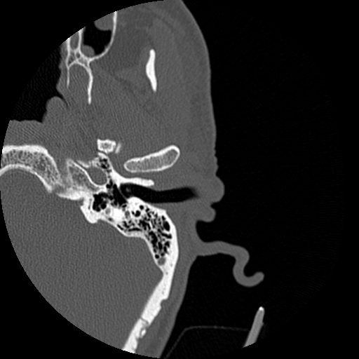 Bilateral temporal bone fractures (Radiopaedia 29482-29970 D 52).jpg