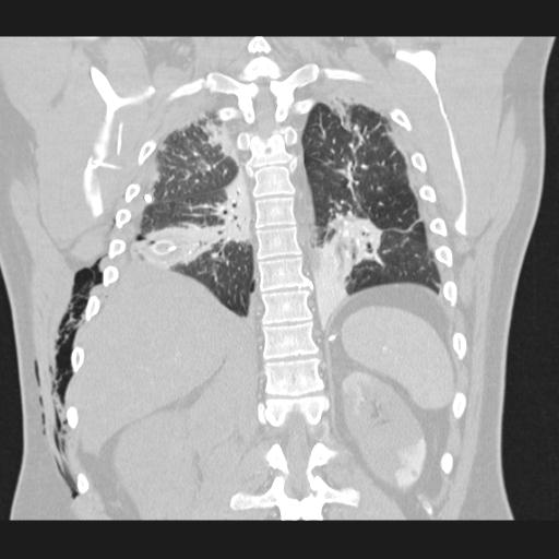 File:Bilateral traumatic renovascular injury (Radiopaedia 32051-32995 Coronal lung window 59).jpg