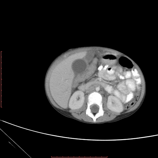 Biliary tract embryonal rhabdomyosarcoma (Radiopaedia 51815-57648 A 65).jpg