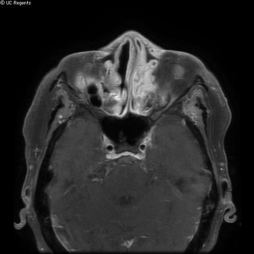 File:Bisphosphonate-related osteonecrosis of the maxilla (Radiopaedia 51367-57101 Axial T1 C+ fat sat 32).jpg