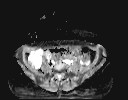 File:Bladder rhabdomyosarcoma (Radiopaedia 27231-27407 Axial ADC 19).jpg