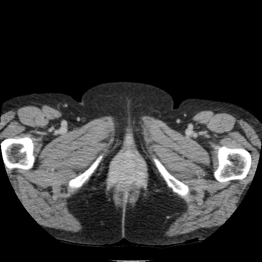 Bladder tumor detected on trauma CT (Radiopaedia 51809-57609 C 151).jpg