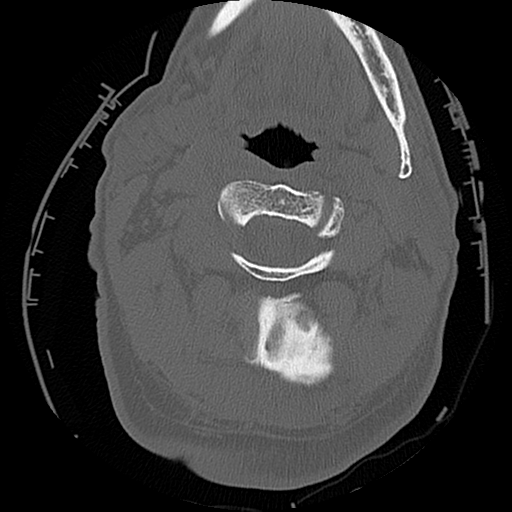 File:Blunt cerebrovascular injury (Radiopaedia 53682-59743 Axial bone window 18).png