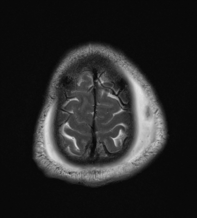 File:Blunt cerebrovascular injury (Radiopaedia 53682-59745 Axial T2 27).png