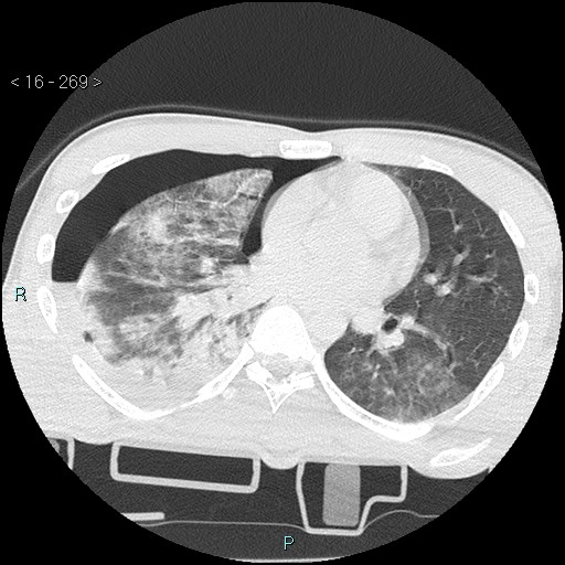 Blunt chest trauma (Swiss cheese sign) (Radiopaedia 38519-40618 Axial lung window 41).jpg