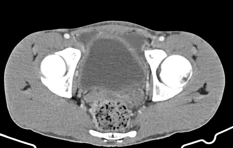 Blunt injury to the small bowel (Radiopaedia 74953-85987 A 178).jpg