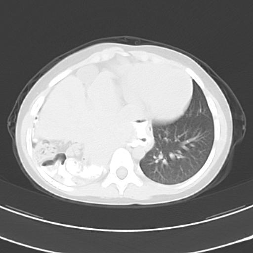 File:Bochdalek diaphragmatic hernia (Radiopaedia 38866-41059 Axial lung window 18).jpg