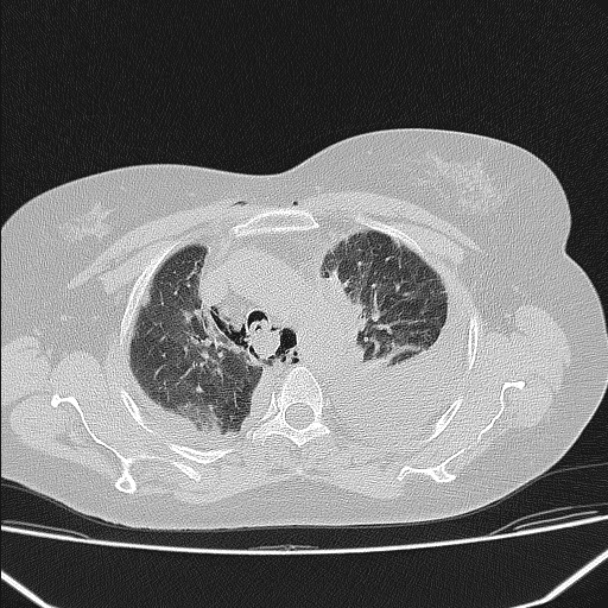 Boerhaave syndrome (Radiopaedia 45644-49799 Axial lung window 45).jpg