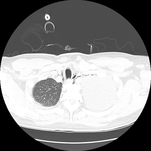 Boerhaave syndrome (Radiopaedia 59796-67310 Axial lung window 13).jpg