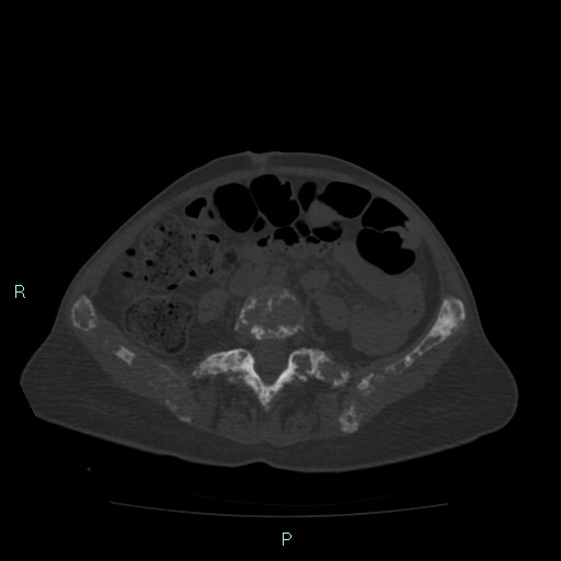 File:Bone metastases from untreated breast cancer (Radiopaedia 42973-46219 Axial bone window 139).jpg