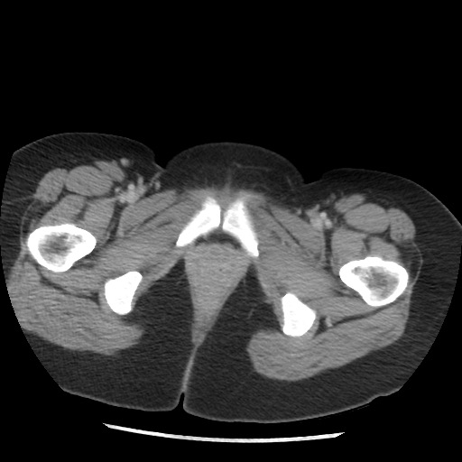 File:Borderline mucinous tumor (ovary) (Radiopaedia 78228-90808 A 142).jpg