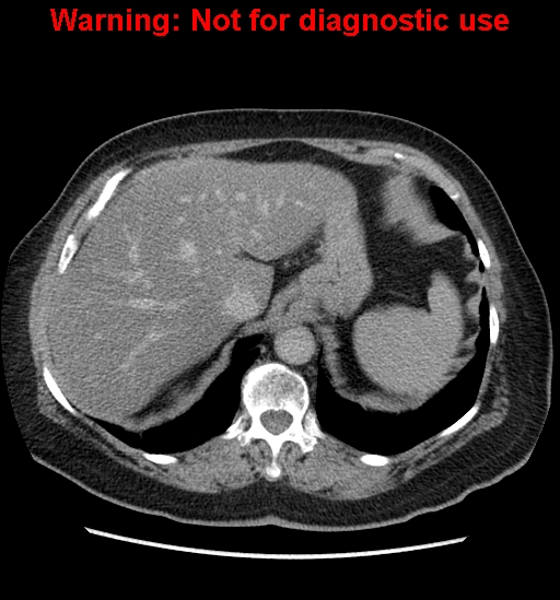File:Bosniak renal cyst - type II (Radiopaedia 23404-23468 F 12).jpg