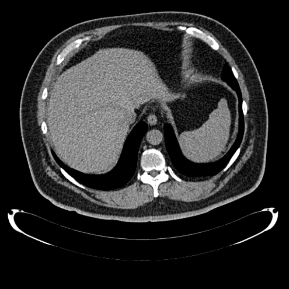 File:Bosniak renal cyst - type IV (Radiopaedia 24244-24518 Axial non-contrast 57).jpg