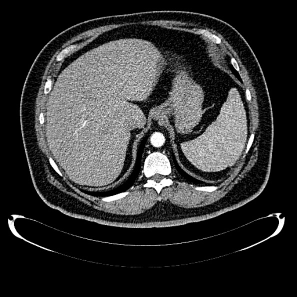 Bosniak renal cyst - type IV (Radiopaedia 24244-24518 B 55).jpg