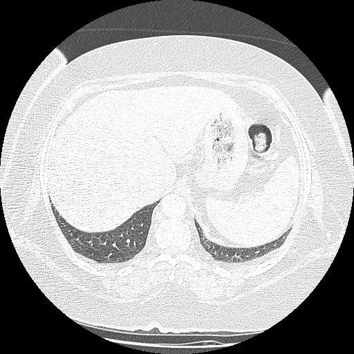 Bovine aortic arch - right internal mammary vein drains into the superior vena cava (Radiopaedia 63296-71875 Axial lung window 160).jpg