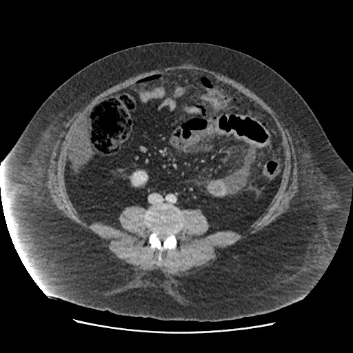 Bowel and splenic infarcts in acute lymphocytic leukemia (Radiopaedia 61055-68915 A 81).jpg