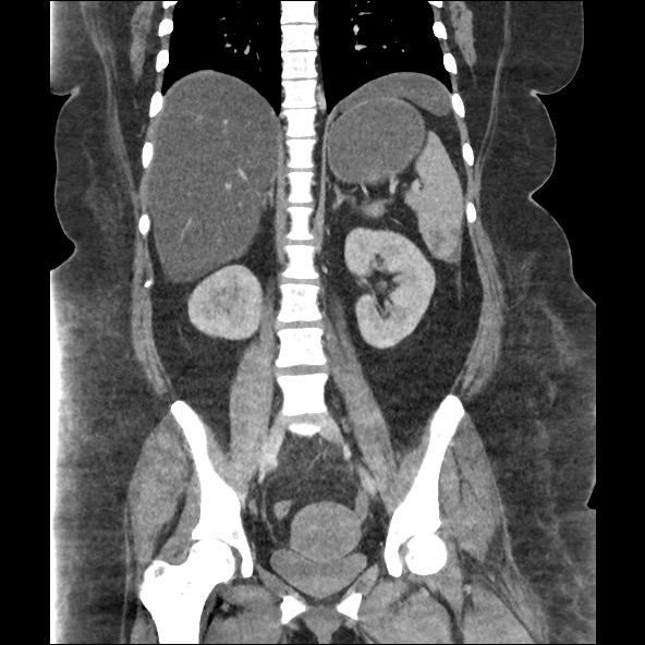 File:Bowel and splenic infarcts in acute lymphocytic leukemia (Radiopaedia 61055-68915 B 39).jpg