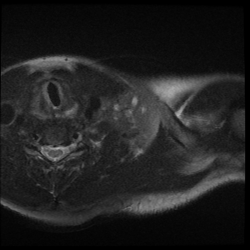 File:Brachial plexus neurofibroma (Radiopaedia 28030-28291 Axial T2 fat sat 14).png