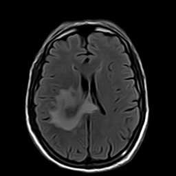 File:Brain abscess complicated by intraventricular rupture and ventriculitis (Radiopaedia 82434-96571 Axial FLAIR 14).jpg