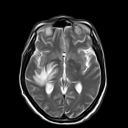 File:Brain abscess complicated by intraventricular rupture and ventriculitis (Radiopaedia 82434-96571 Axial T2 12).jpg