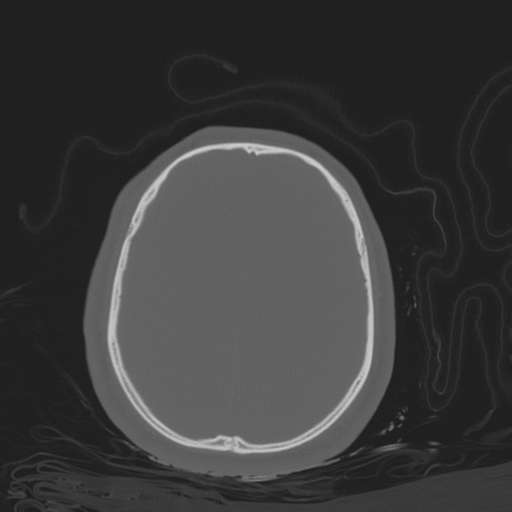 File:Brain contusions, internal carotid artery dissection and base of skull fracture (Radiopaedia 34089-35339 Axial bone window 94).png