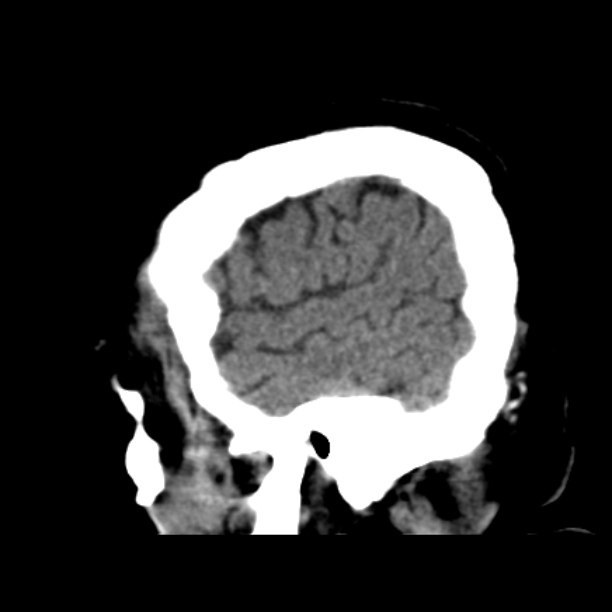Brain cortical laminar necrosis (Radiopaedia 25822-25971 non-contrast 9).jpg