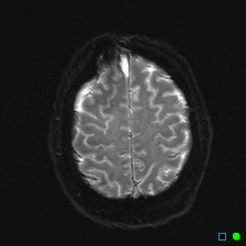 File:Brain death on MRI and CT angiography (Radiopaedia 42560-45689 Axial ADC 26).jpg