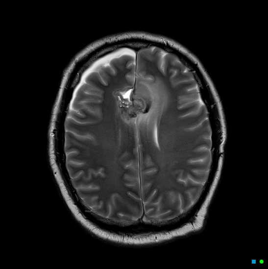 File:Brain death on MRI and CT angiography (Radiopaedia 42560-45689 Axial T2 22).jpg