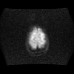 File:Brainstem glioma (Radiopaedia 30923-31624 Axial DWI 17).jpg