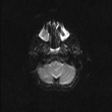 Brainstem glioma (Radiopaedia 67531-76922 Axial DWI 5).jpg