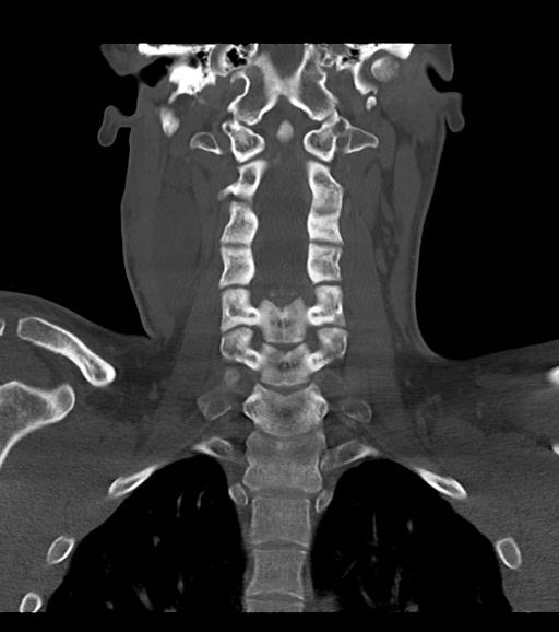 Branchial cleft cyst (Radiopaedia 31167-31875 Coronal bone window 41).jpg