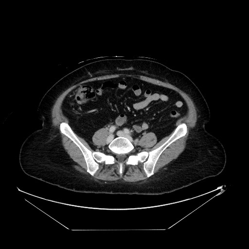 File:Breast cancer pseudocirrhosis with lobar invovlement (Radiopaedia 81080-94670 A 108).jpg