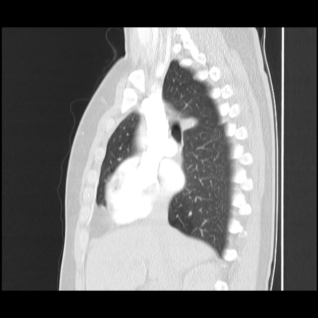 Bronchial atresia (Radiopaedia 22965-22992 Sagittal lung window 32).jpg