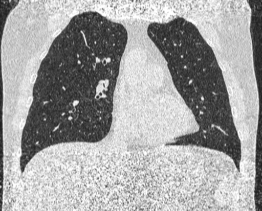 Bronchial atresia (Radiopaedia 58271-65417 Coronal lung window 21).jpg