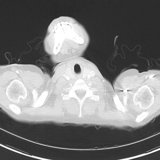 Bronchial atresia (Radiopaedia 73677-84470 Axial lung window 3).jpg