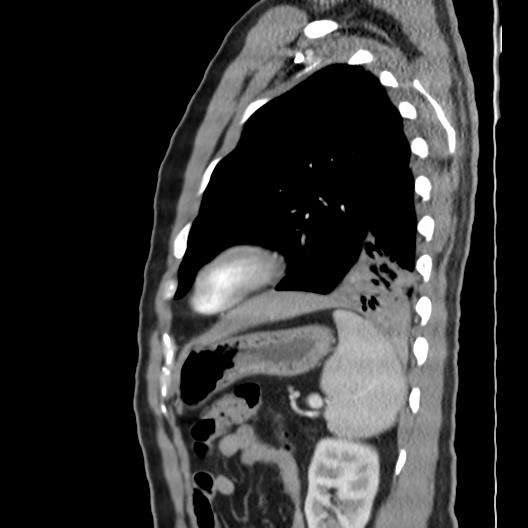 File:Bronchial carcinoid (Radiopaedia 80013-93291 Sagittal C+ CTPA 2).jpg