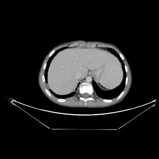 Bronchial carcinoid tumor (Radiopaedia 57187-64090 A 67).jpg