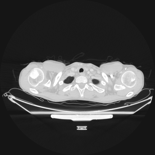 File:Bronchial carcinoid tumor (Radiopaedia 57187-64090 Axial lung window 2).jpg